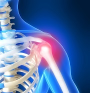 4 causes de douleurs dans les épaules